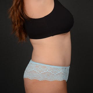 Tummy Tuck Before & After Gallery - Patient 288953 - Image 6