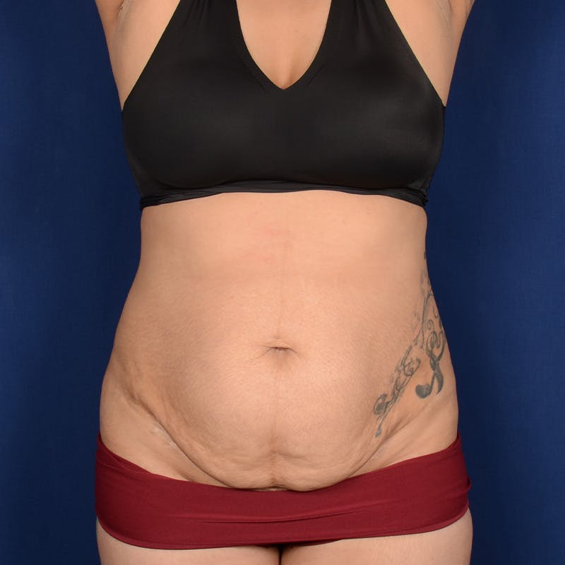 Tummy Tuck Before & After Gallery - Patient 171203 - Image 1