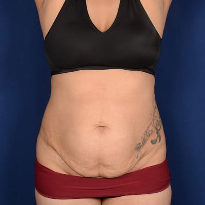 Tummy Tuck Before & After Gallery - Patient 171203 - Image 1