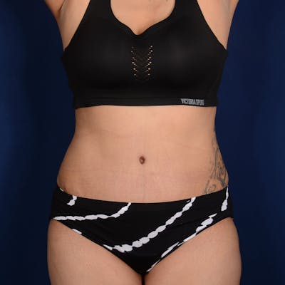 Tummy Tuck Before & After Gallery - Patient 171203 - Image 2