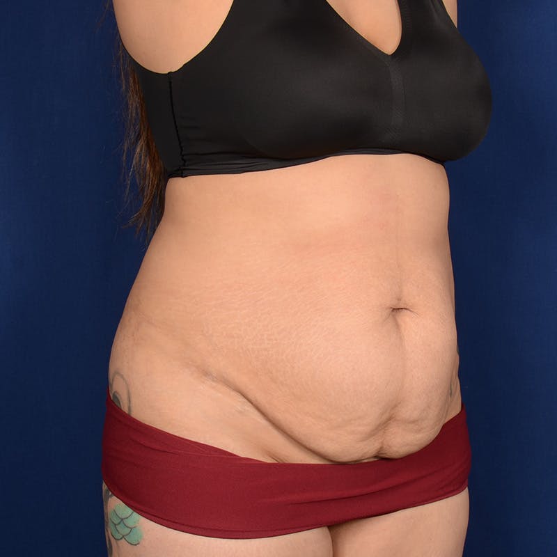 Tummy Tuck Before & After Gallery - Patient 171203 - Image 3
