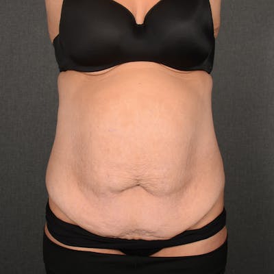 Tummy Tuck Before & After Gallery - Patient 202847 - Image 1