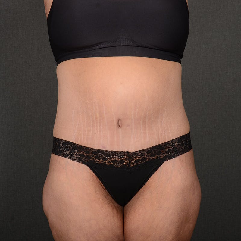 Tummy Tuck Before & After Gallery - Patient 202847 - Image 2