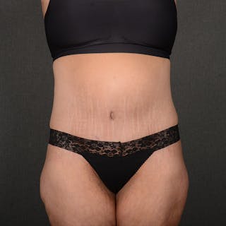 Tummy Tuck Before & After Gallery - Patient 202847 - Image 2