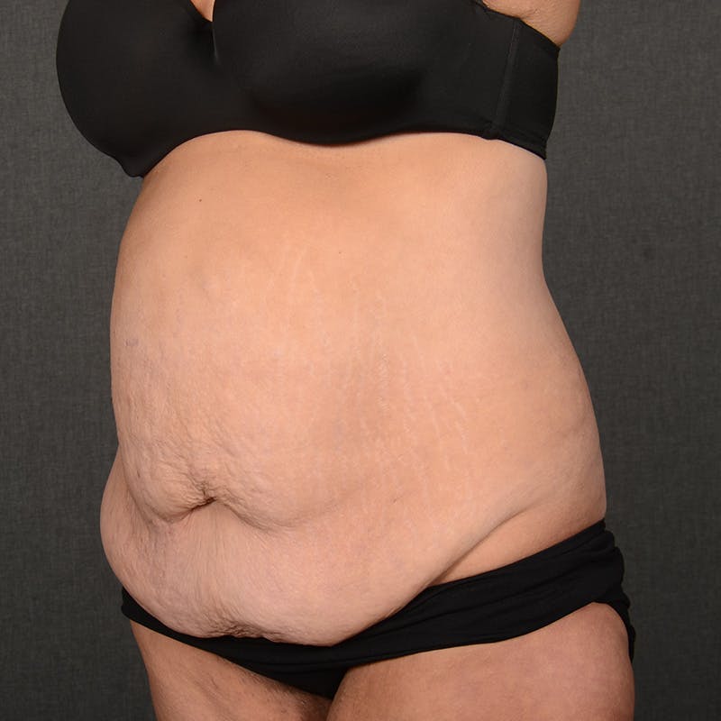 Tummy Tuck Before & After Gallery - Patient 202847 - Image 3
