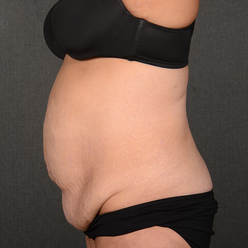 Tummy Tuck Before & After Gallery - Patient 202847 - Image 5