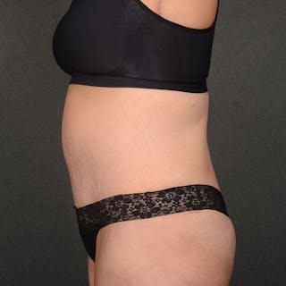 Tummy Tuck Before & After Gallery - Patient 202847 - Image 6