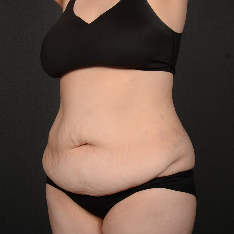 Tummy Tuck Before & After Gallery - Patient 127315 - Image 3