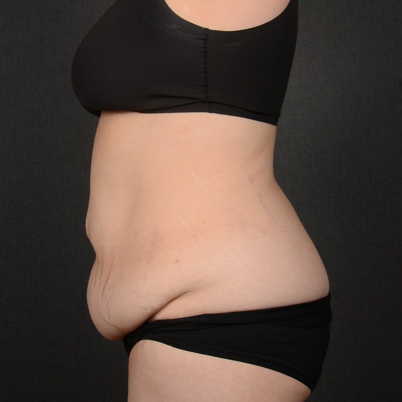 Tummy Tuck Before & After Gallery - Patient 127315 - Image 5