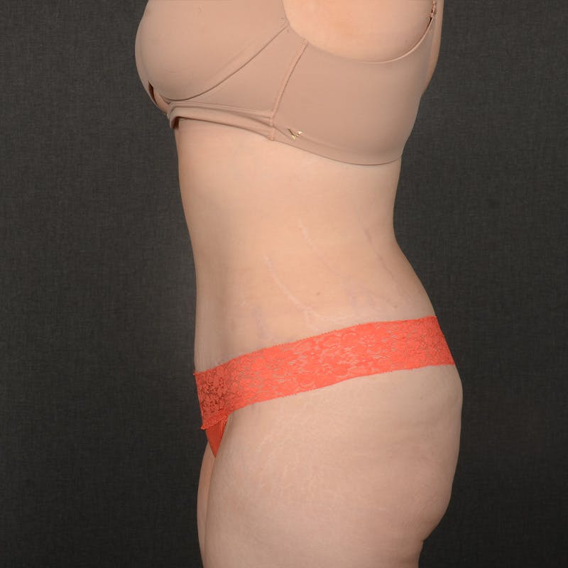 Tummy Tuck Before & After Gallery - Patient 127315 - Image 6