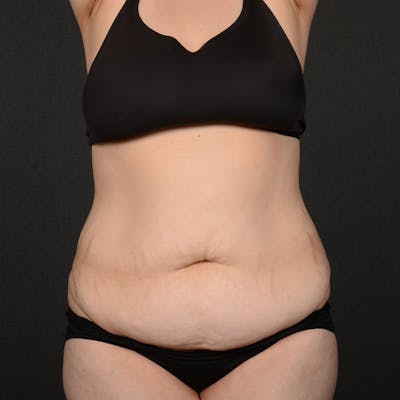 Tummy Tuck Before & After Gallery - Patient 127315 - Image 1