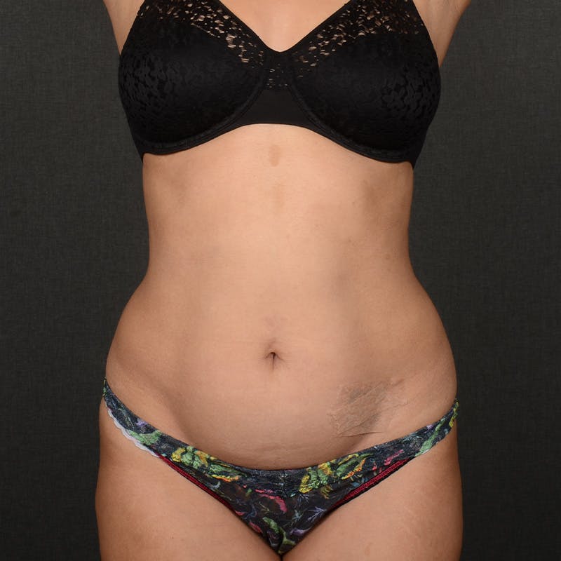 Tummy Tuck Before & After Gallery - Patient 267617 - Image 1
