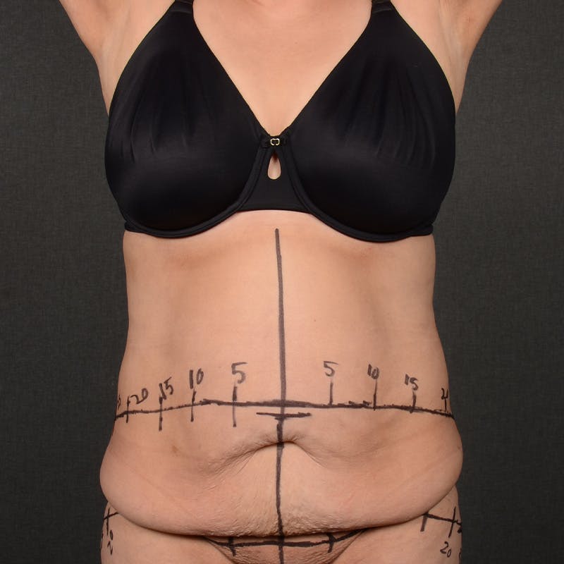 Tummy Tuck Before & After Gallery - Patient 298030 - Image 1