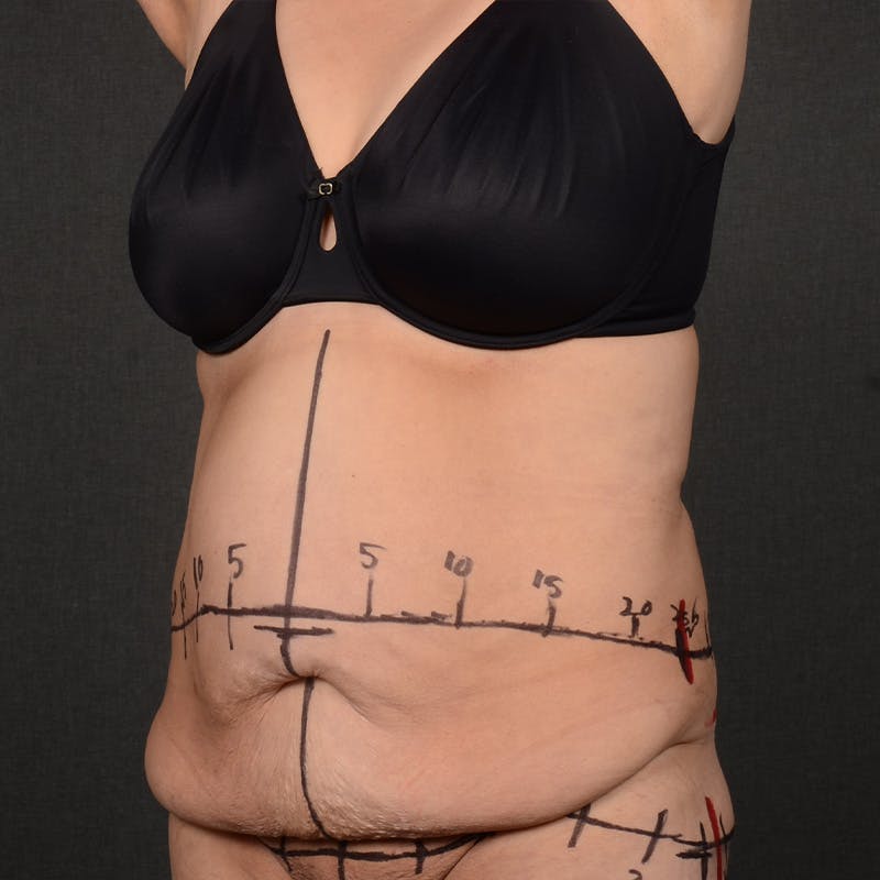 Tummy Tuck Before & After Gallery - Patient 298030 - Image 3