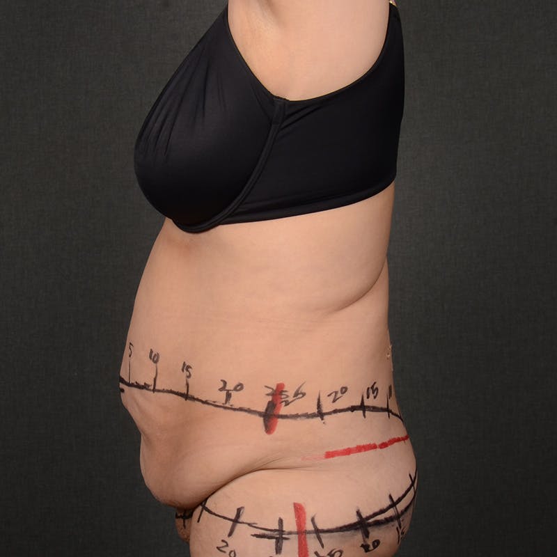 Tummy Tuck Before & After Gallery - Patient 298030 - Image 5
