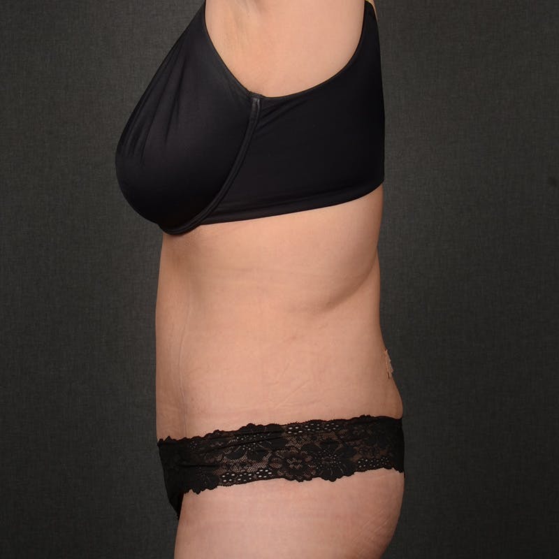 Tummy Tuck Before & After Gallery - Patient 298030 - Image 6