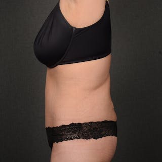 Tummy Tuck Before & After Gallery - Patient 298030 - Image 6