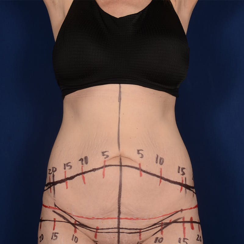 Tummy Tuck Before & After Gallery - Patient 235389 - Image 1