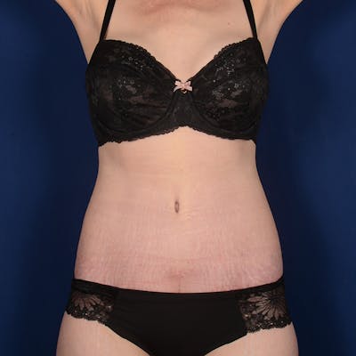Tummy Tuck Before & After Gallery - Patient 235389 - Image 2