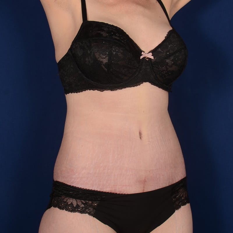 Tummy Tuck Before & After Gallery - Patient 235389 - Image 4
