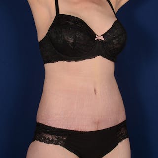 Tummy Tuck Before & After Gallery - Patient 235389 - Image 4