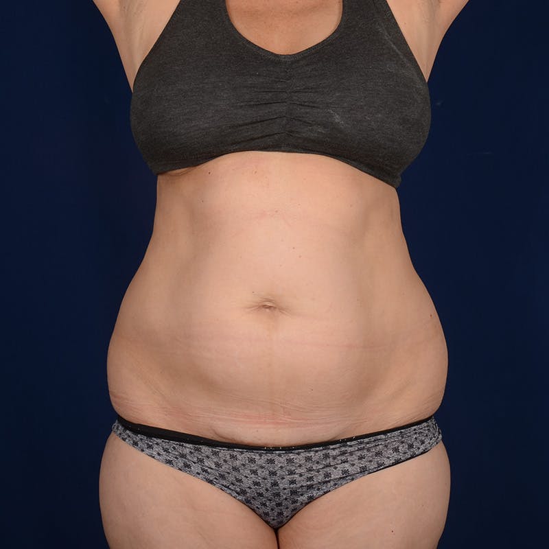 Tummy Tuck Before & After Gallery - Patient 882133 - Image 1