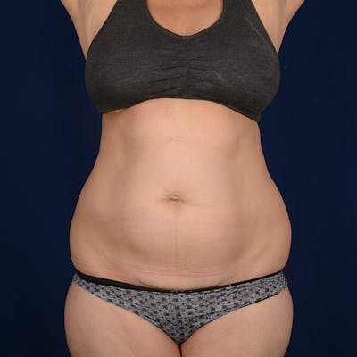 Tummy Tuck Before & After Gallery - Patient 882133 - Image 1