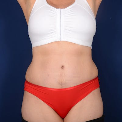 Tummy Tuck Before & After Gallery - Patient 882133 - Image 2