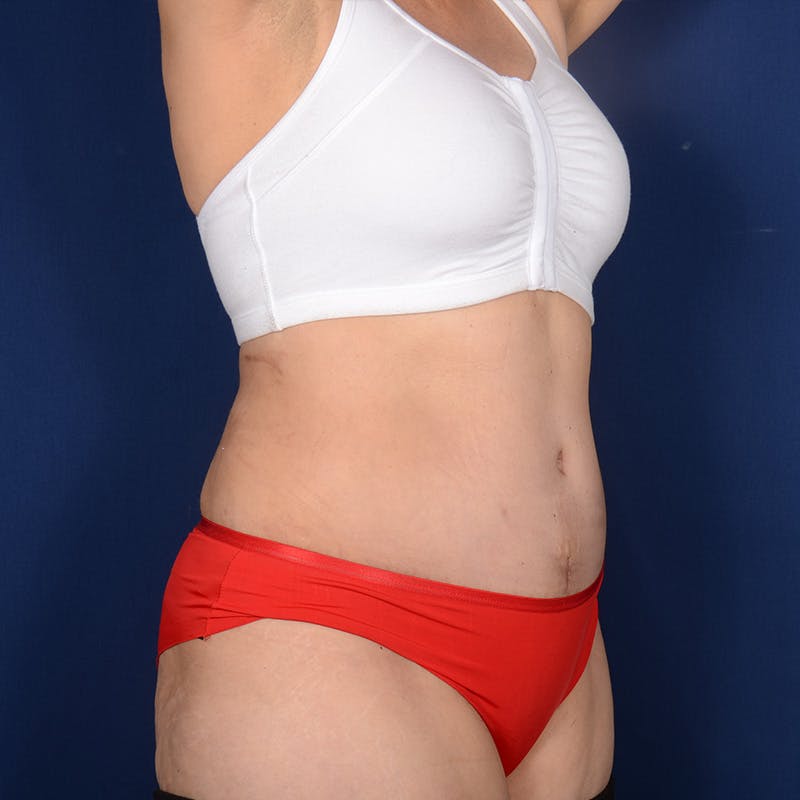 Tummy Tuck Before & After Gallery - Patient 882133 - Image 4