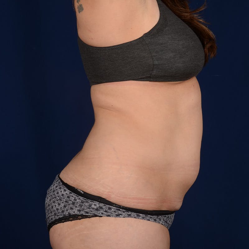 Tummy Tuck Before & After Gallery - Patient 882133 - Image 5