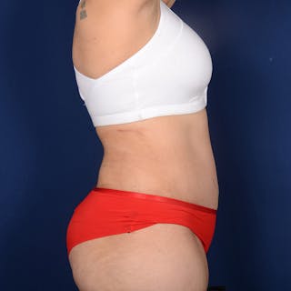 Tummy Tuck Before & After Gallery - Patient 882133 - Image 6