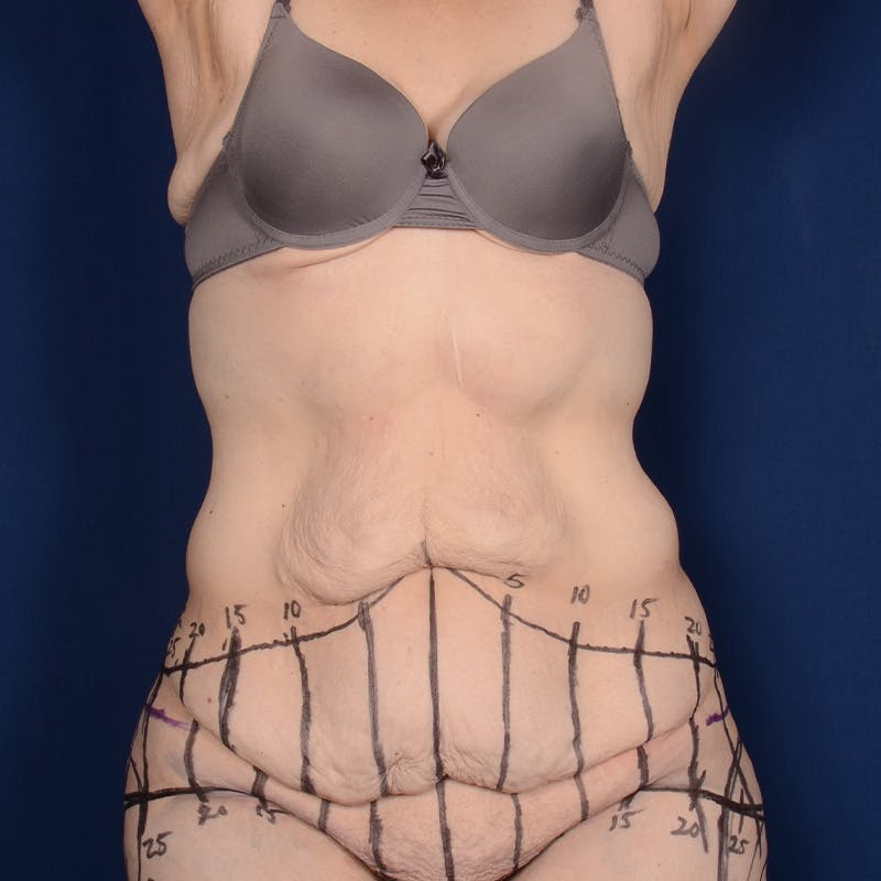 Tummy Tuck Before & After Gallery - Patient 255259 - Image 1