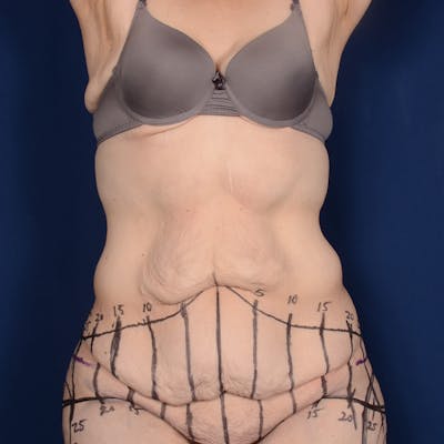 Tummy Tuck Before & After Gallery - Patient 255259 - Image 1