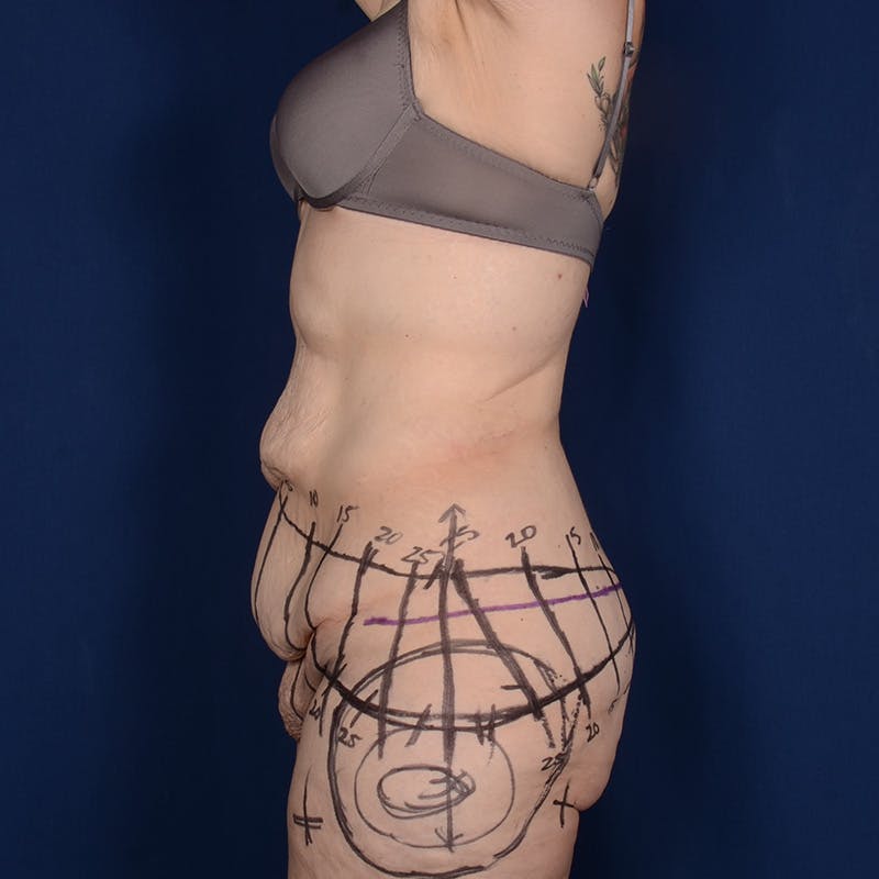 Tummy Tuck Before & After Gallery - Patient 255259 - Image 5