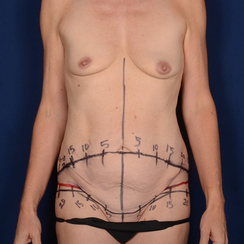Tummy Tuck Before & After Gallery - Patient 428942 - Image 1