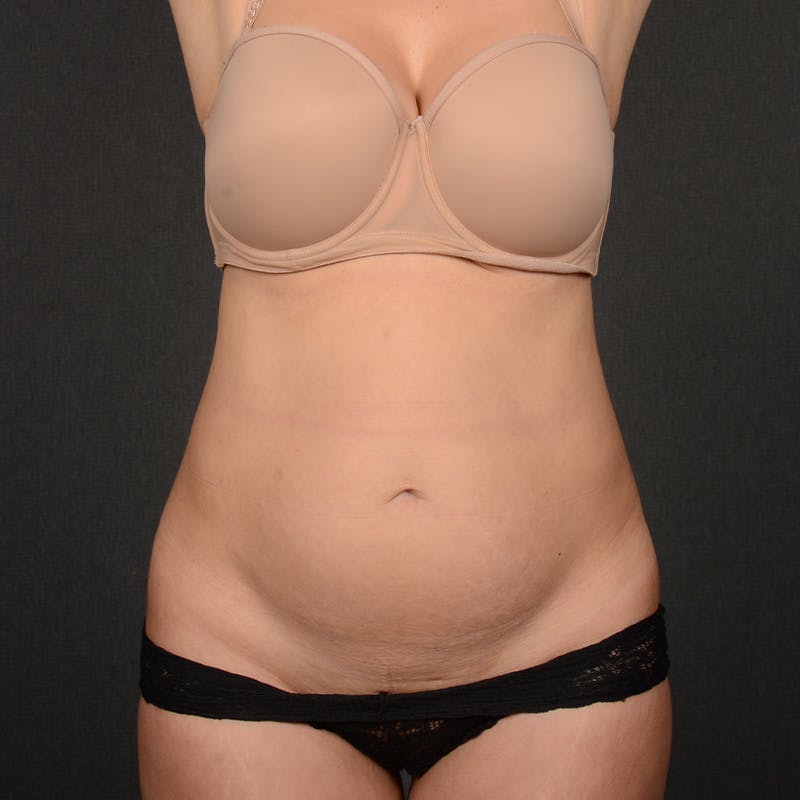 Tummy Tuck Before & After Gallery - Patient 258415 - Image 1