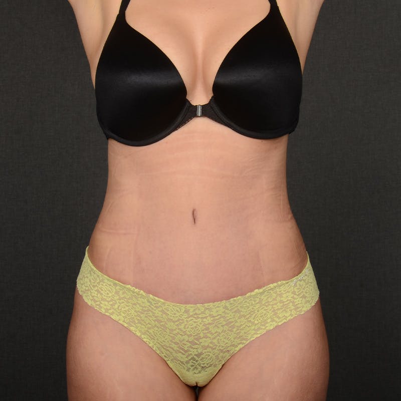 Tummy Tuck Before & After Gallery - Patient 258415 - Image 2