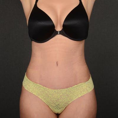 Tummy Tuck Before & After Gallery - Patient 258415 - Image 2