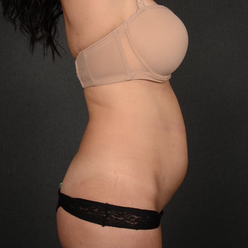 Tummy Tuck Before & After Gallery - Patient 258415 - Image 5