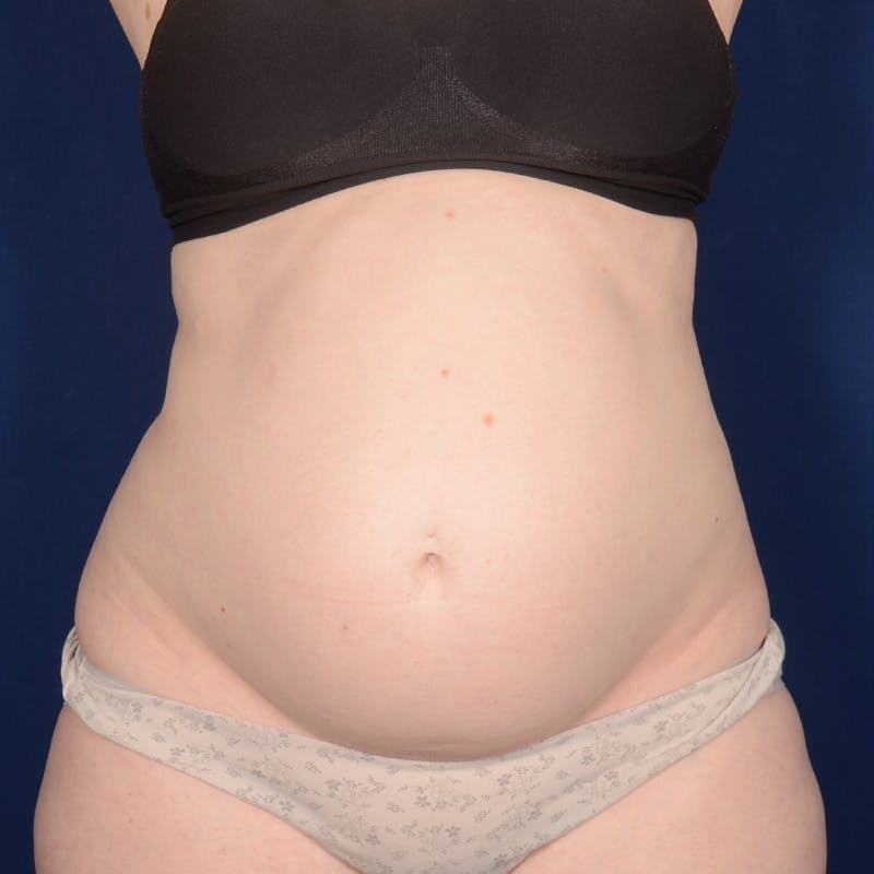 Tummy Tuck Before & After Gallery - Patient 284106 - Image 1