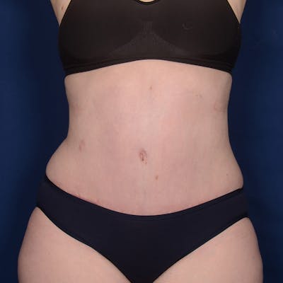 Tummy Tuck Before & After Gallery - Patient 284106 - Image 2