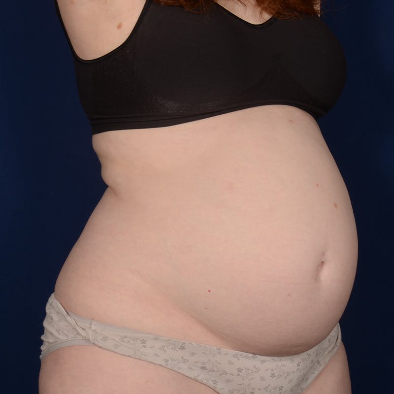 Tummy Tuck Before & After Gallery - Patient 284106 - Image 3