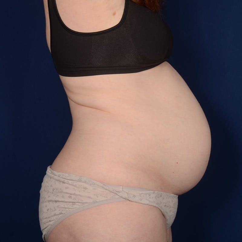 Tummy Tuck Before & After Gallery - Patient 284106 - Image 5
