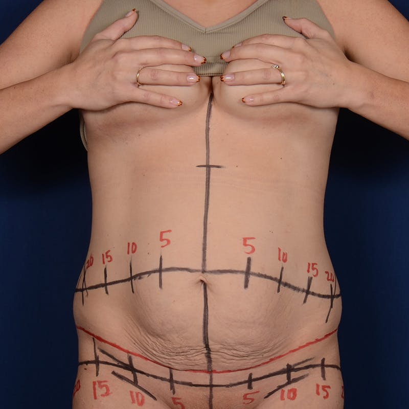 Tummy Tuck Before & After Gallery - Patient 190043 - Image 1