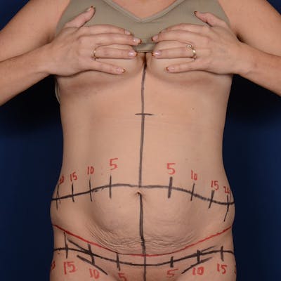 Tummy Tuck Before & After Gallery - Patient 190043 - Image 1