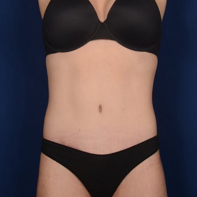 Tummy Tuck Before & After Gallery - Patient 190043 - Image 2