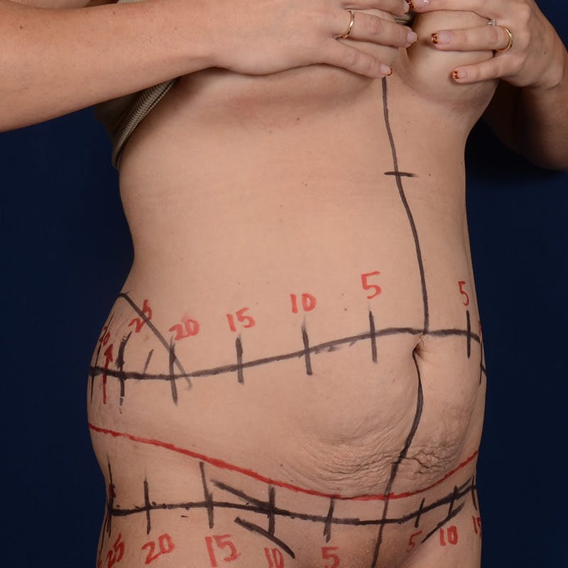 Tummy Tuck Before & After Gallery - Patient 190043 - Image 3