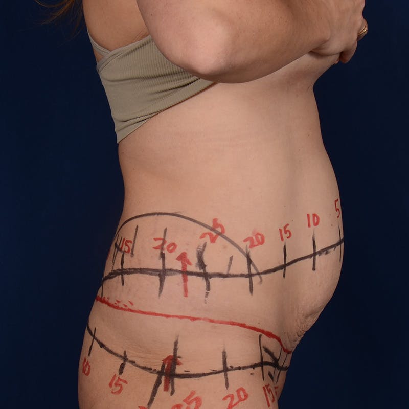 Tummy Tuck Before & After Gallery - Patient 190043 - Image 5