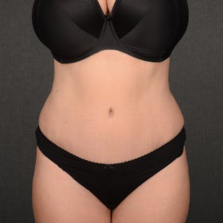 Tummy Tuck Before & After Gallery - Patient 391961 - Image 2