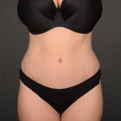 Tummy Tuck Before & After Gallery - Patient 391961 - Image 2